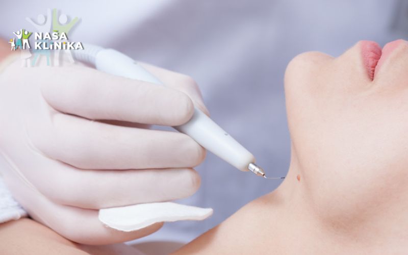 Naša klinika | Uklanjanje bradavica i kondiloma na bezbjedan i efikasan način uz iskustvo, preciznost i vrhunsku medicinsku njegu!